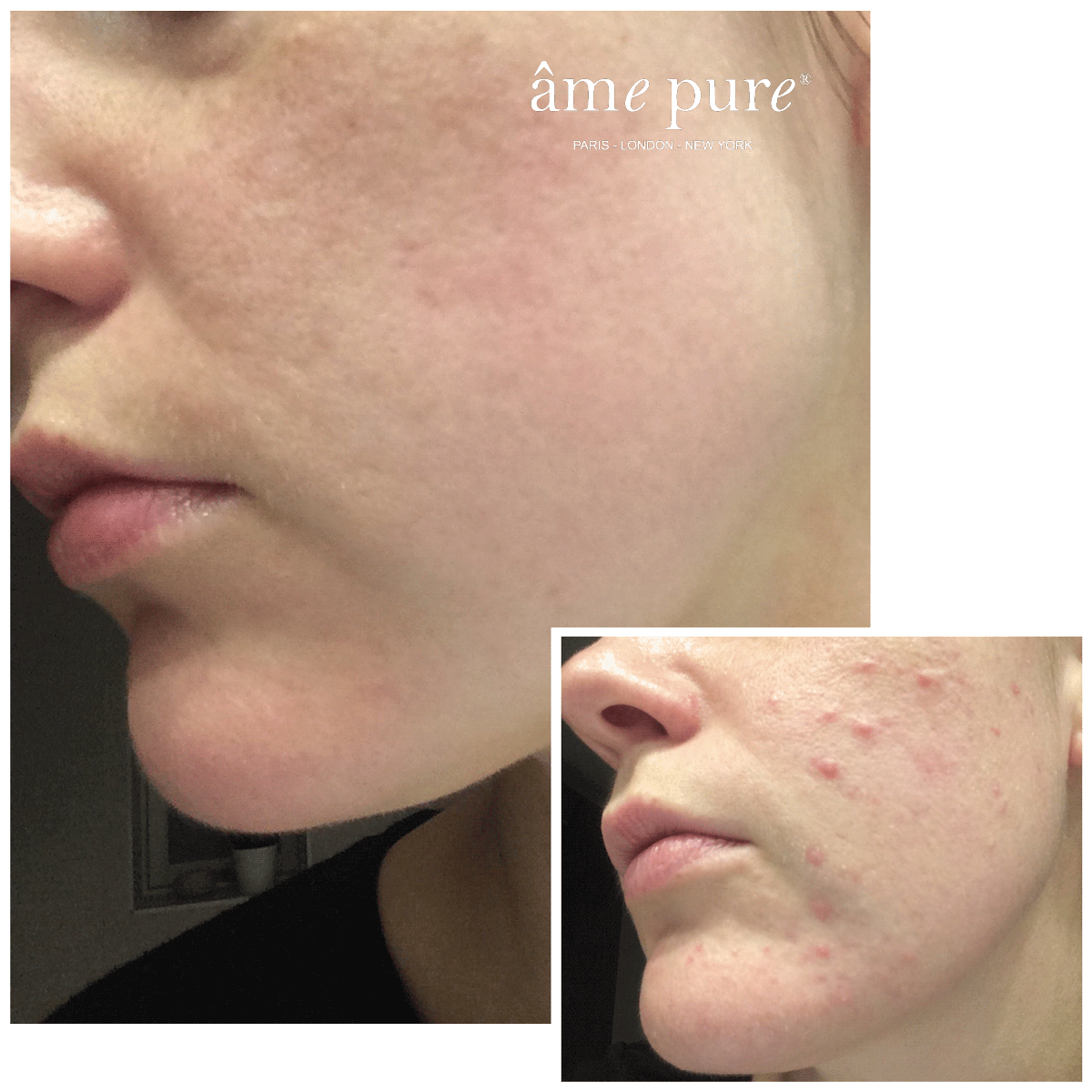 CIT Face Roller PLATINUM