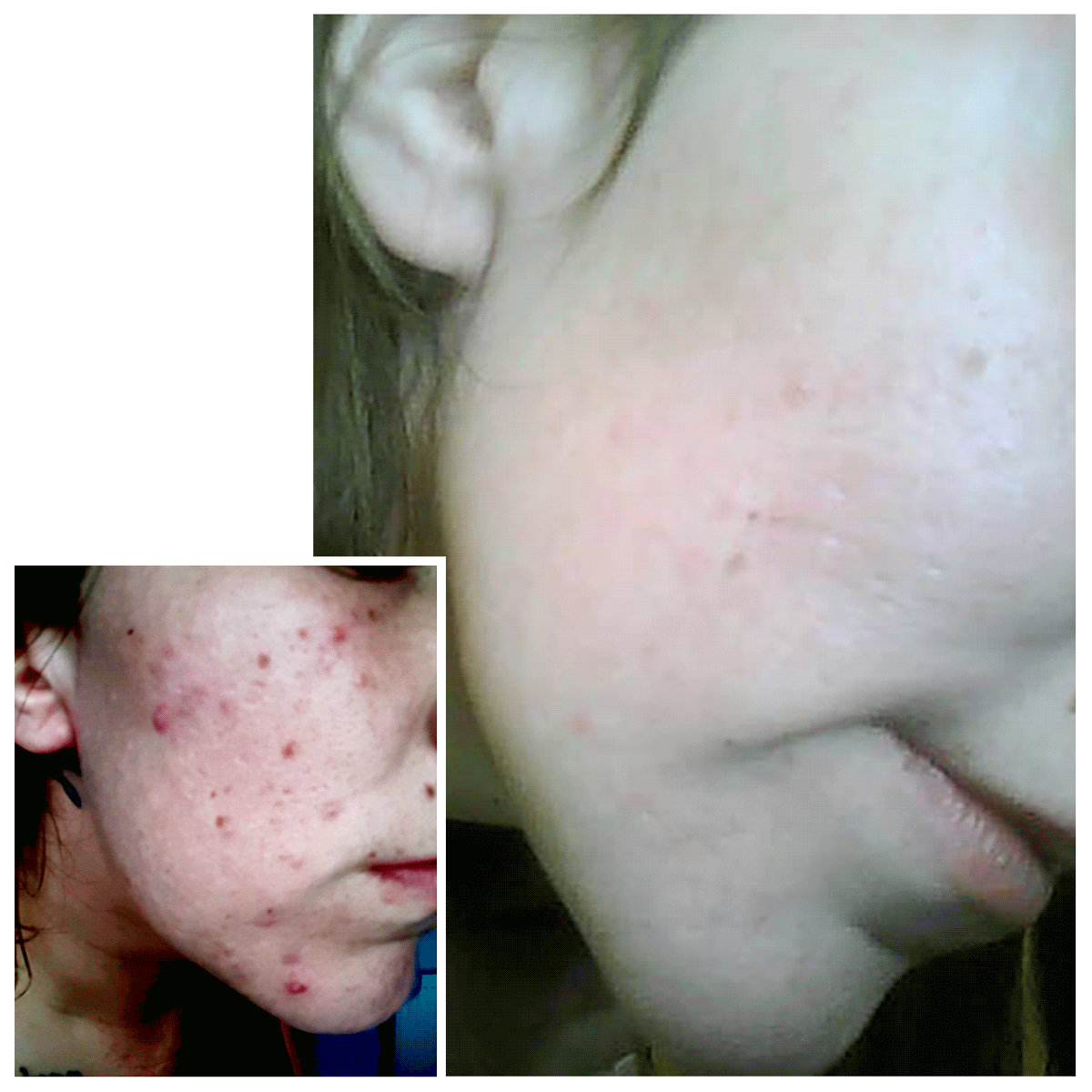 CIT Face Roller PLATINUM