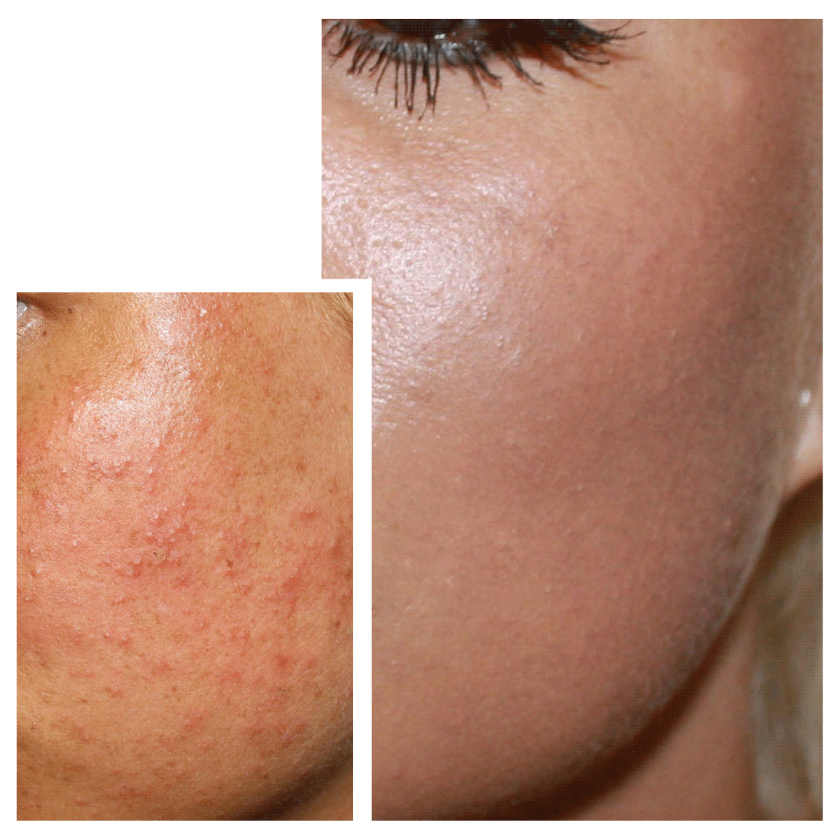 CIT Face Roller PLATINUM