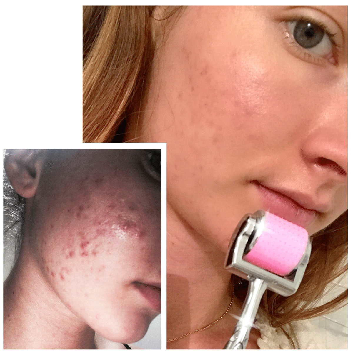 CIT Face Roller PLATINUM