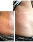 Body Basic | Stretch Marks