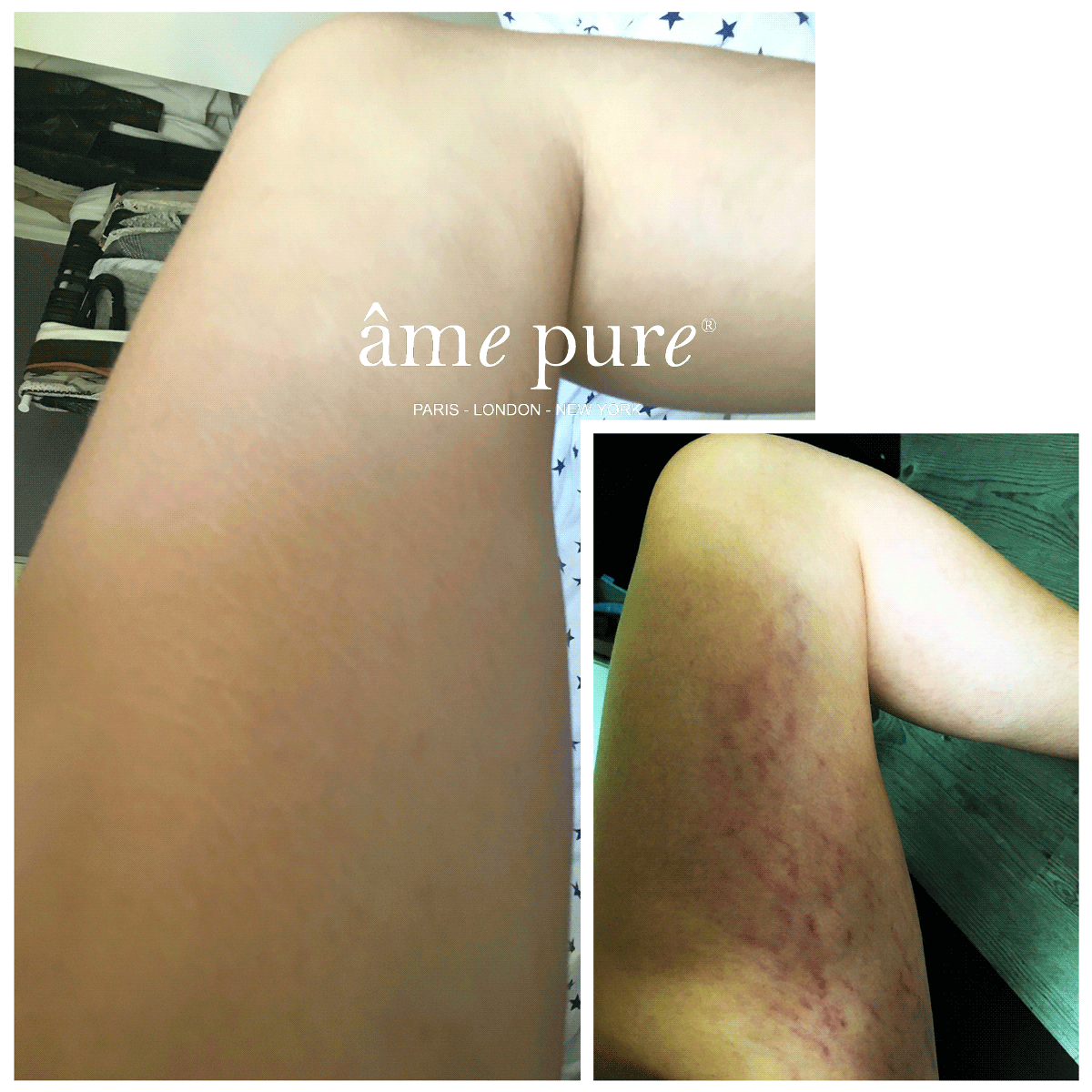 2 für 1 | Body Basic | Stretch Marks