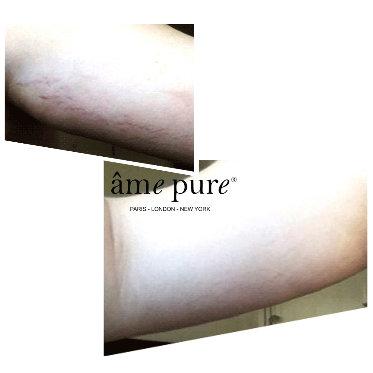 2 für 1 | Body Basic | Stretch Marks